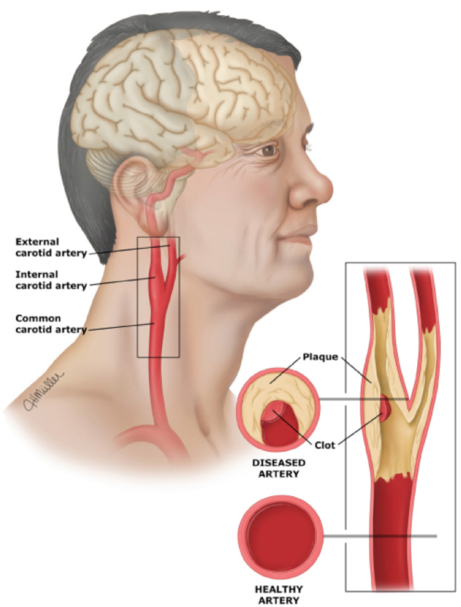 Carotid Artery Disease Stroke Victorian Vascular
