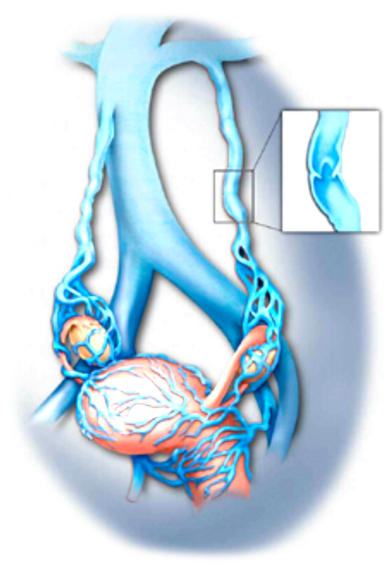 Pelvic Congestion Syndrome - Victorian Vascular